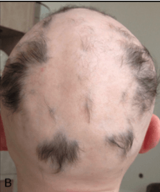 Should We be Treating Hair Loss with Fecal Material?