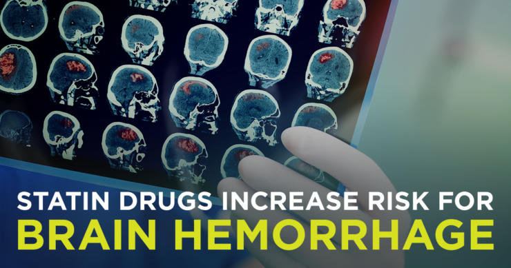 Statin Drugs Increase Risk for Brain Hemorrhage