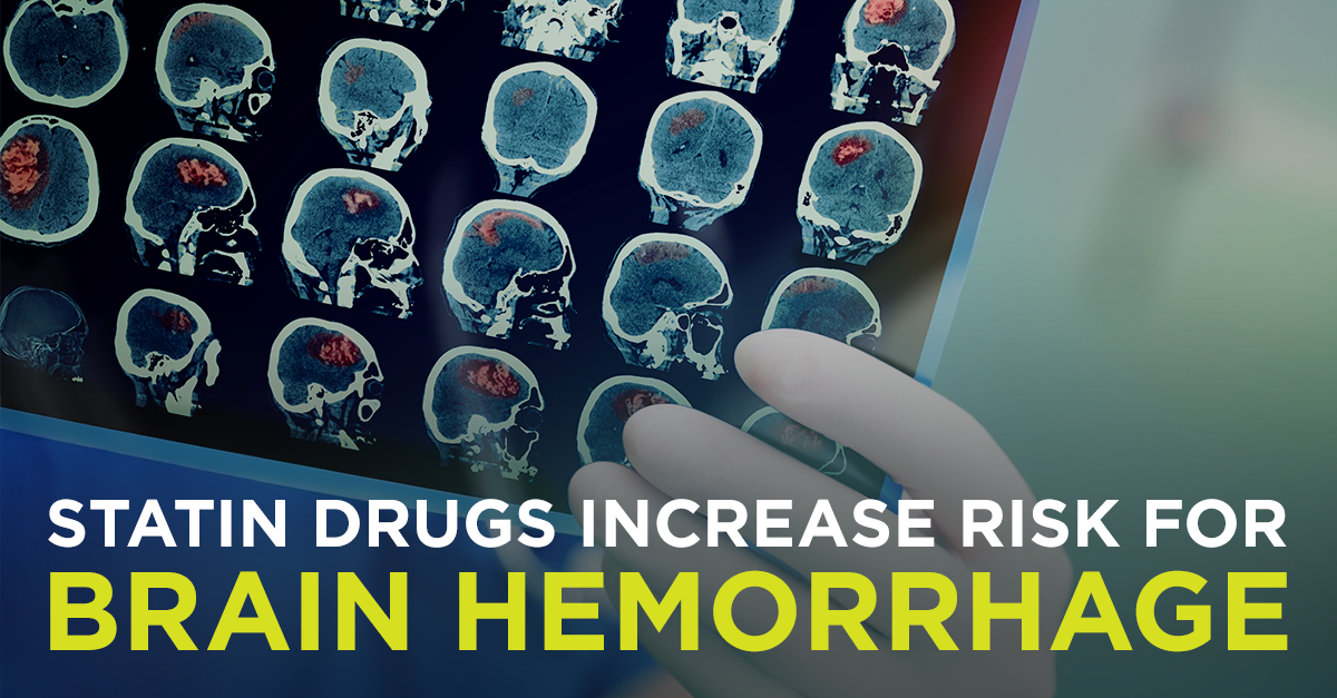 Statin Drugs Increase Risk for Brain Hemorrhage David Perlmutter M.D.