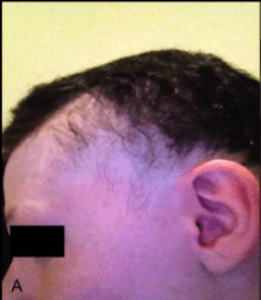 alopecia_hair_loss_a