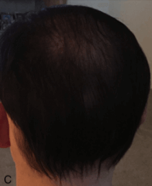 alopecia_hair_loss_c